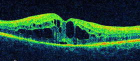 ophthalmic-photography-optical-coherence-tomography-scan-macular-edema